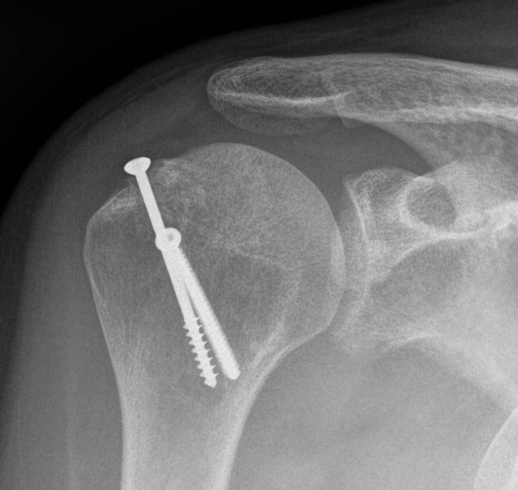 Humeral Head Allograft AP